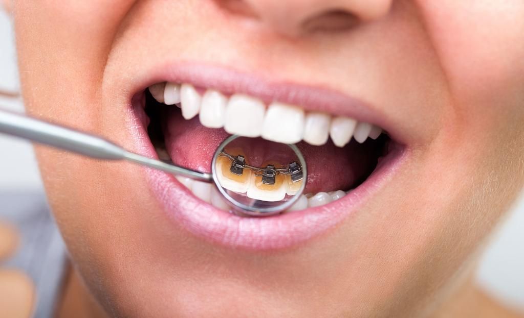 A woman is getting her teeth examined by a dentist.