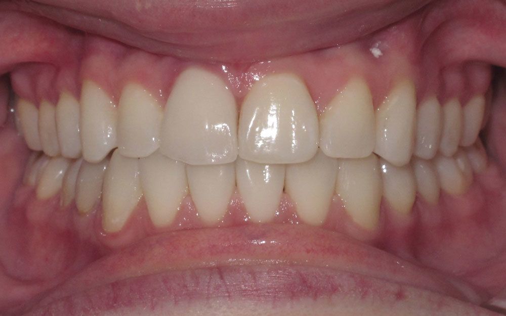 A close up of a person 's teeth with white teeth.