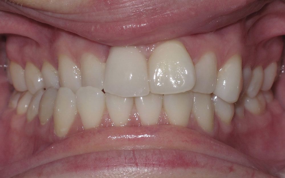 A close up of a person 's teeth and mouth.