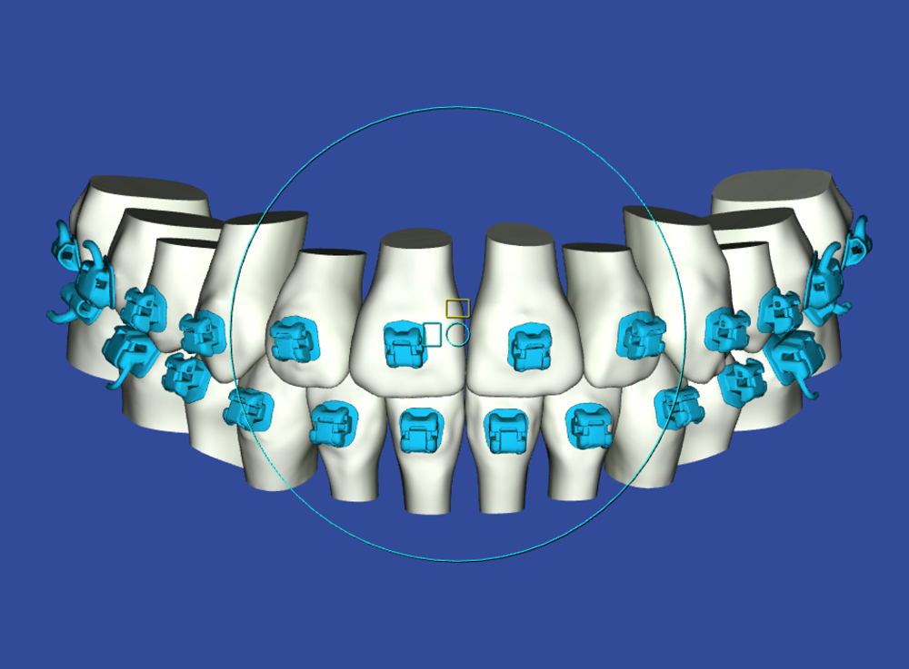 A computer generated image of a person 's teeth with blue braces.