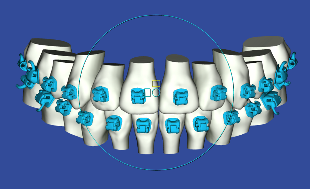 A computer generated image of a person 's teeth with blue braces.