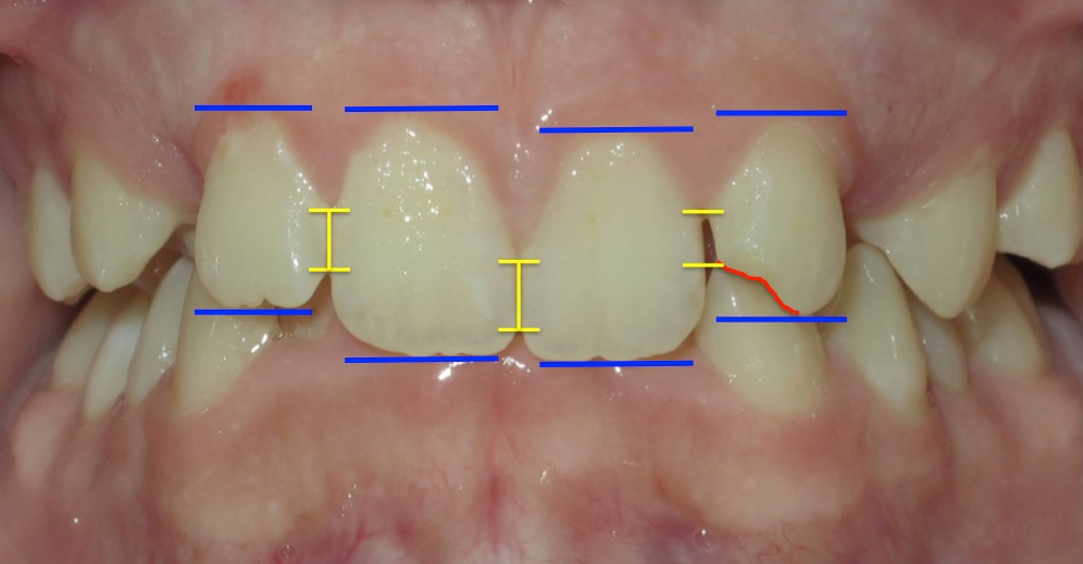 A close up of a person 's teeth with blue and yellow lines