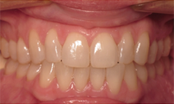 A close up of a person 's teeth with white teeth