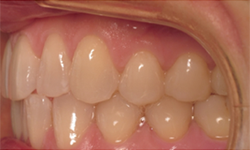 A close up of a person 's teeth with a metal brace.