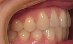 A close up of a person 's teeth and gums.