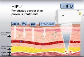 melbourne HIFU - see the best and only HIFU specialist in melbourne. 