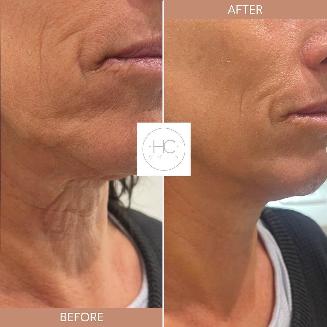 HIFU is a fantastic treatment that provides great results. Read our client's reviews of our HIFU