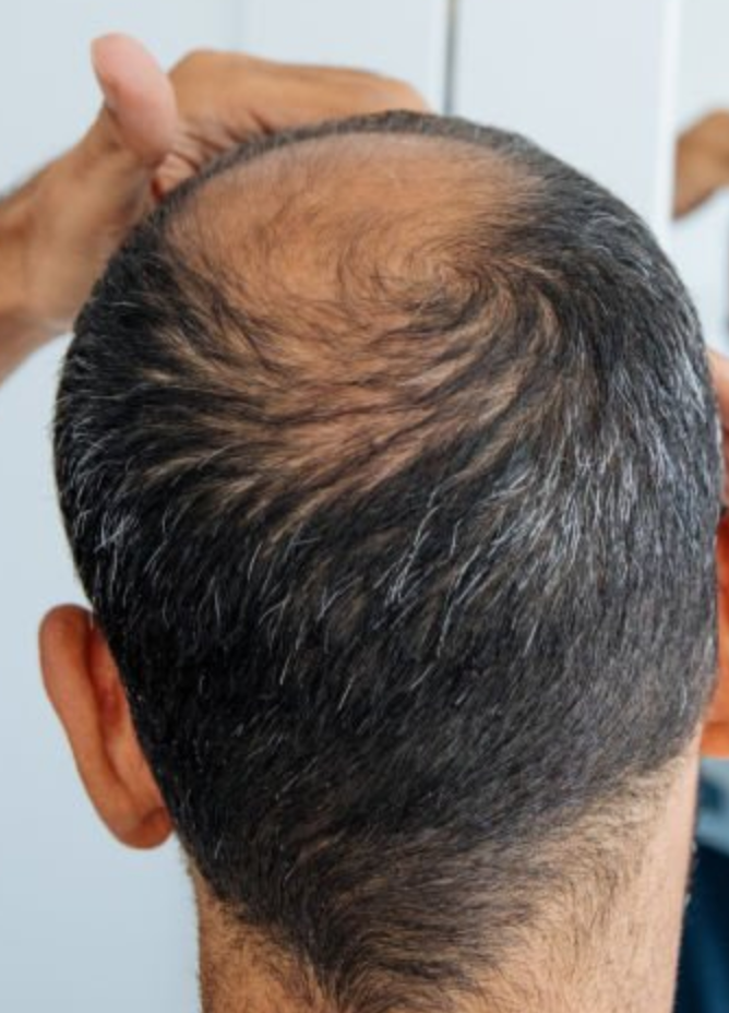 Exosomal hair restoration is gaining attention as an innovative and promising treatment option.