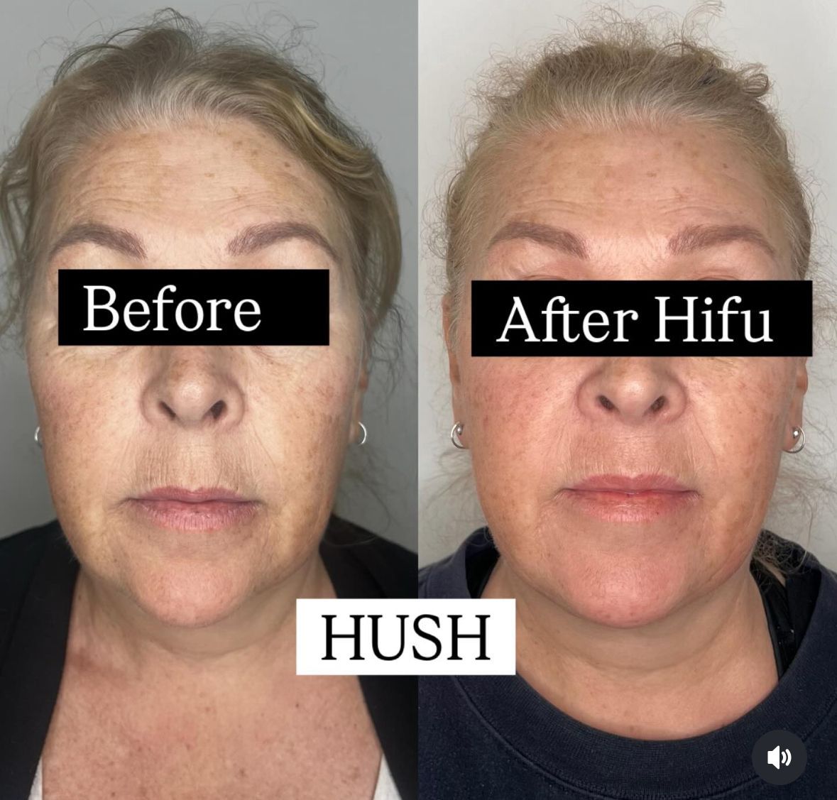 This is a photo of before and after 2 HIFU sessions incresed volume lifted fat pads