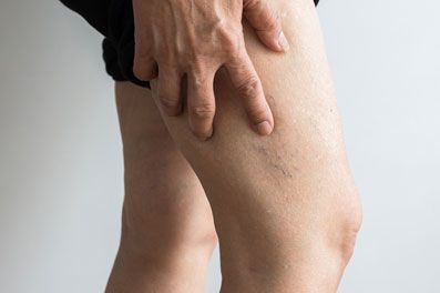 Deep Vein Thrombosis