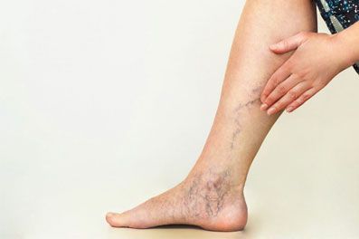 Varicose veins Treatments