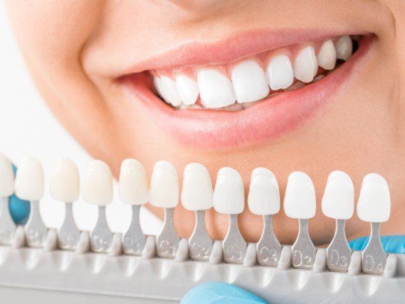 Dr. Jeffrey Wert & Associates, teeth whitening