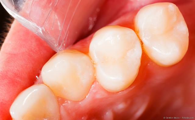 Metallfreie Füllungen aus Komposit oder Keramik