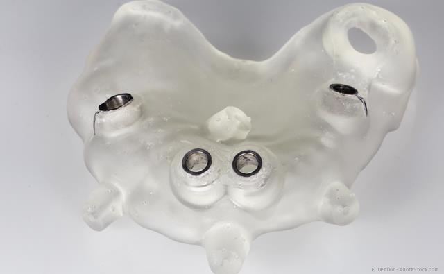 Bohrschablone für Implantate