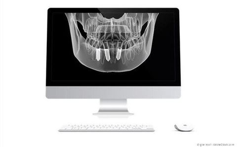 3D-Planung Implantation