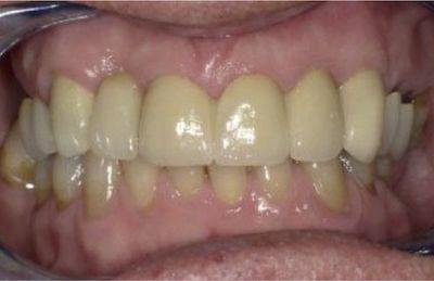 Ästhetisches Ergebnis nach Versorgung der Zähne mit Keramikkronen
