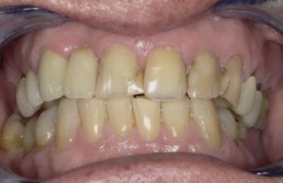 Stark geschädigte Schneide- und Eckzähne mit defekten Zahnfüllungen