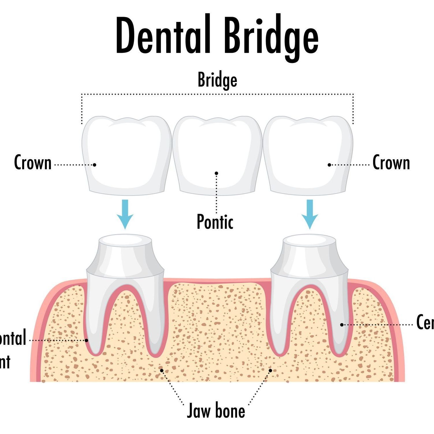 dental bridge crowns and bridges