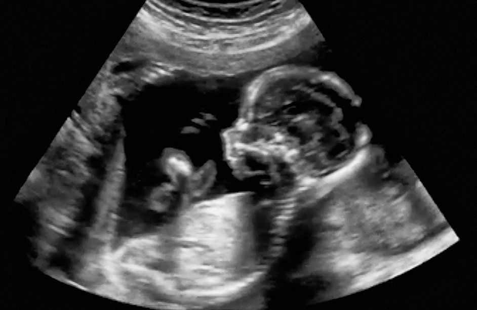 Centro médico Santa Anita-Ecografías Primer Trimestre