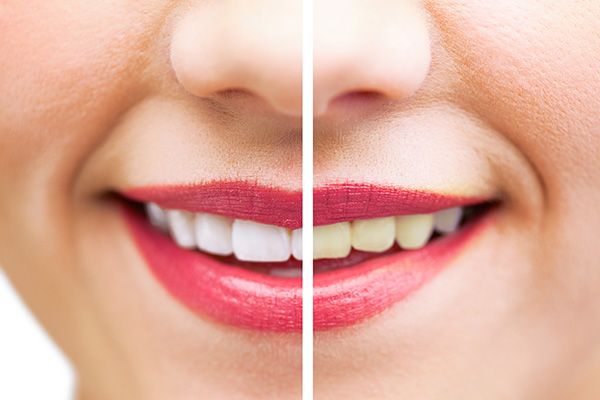 een close-up van de mond van een vrouw voor en na het bleken van haar tanden.