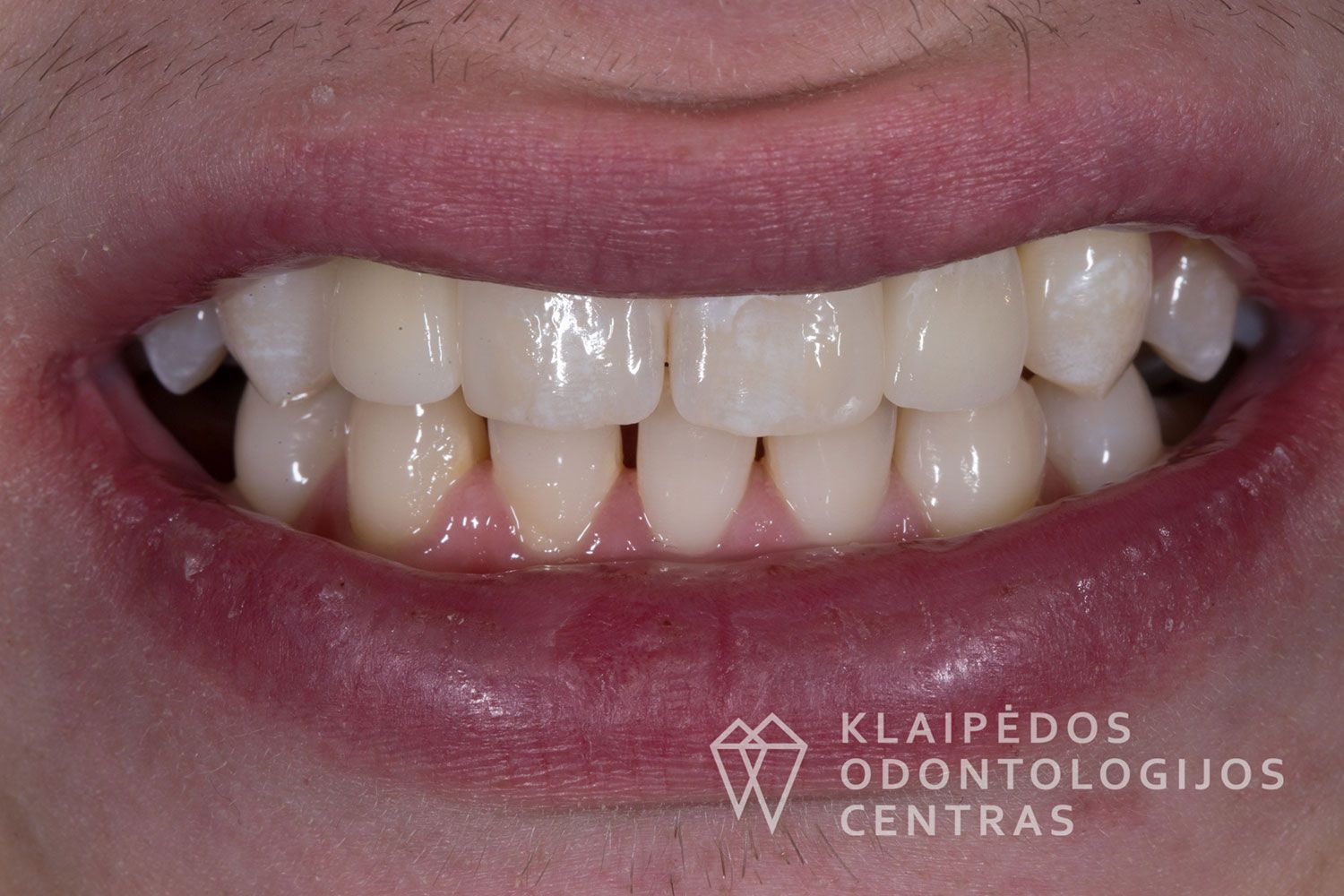 Cirkonio keramika ant implantų