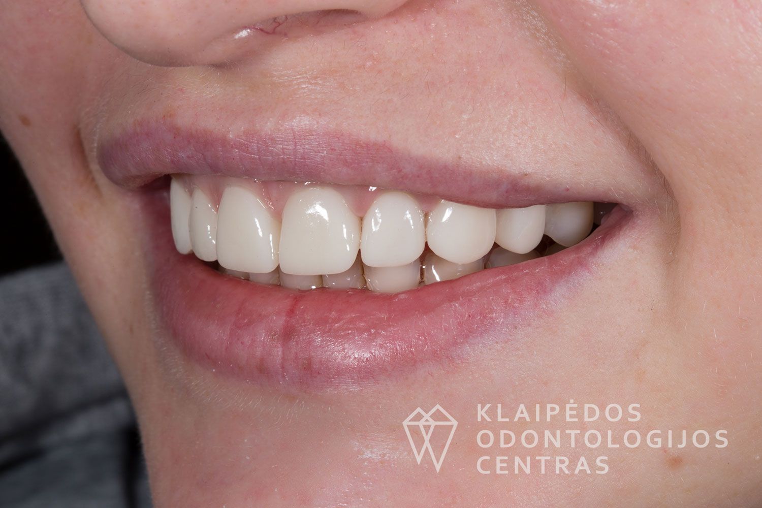 Estetinis protezavimas