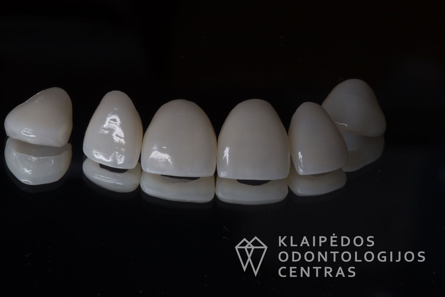 Priekinių dantų laminatės
