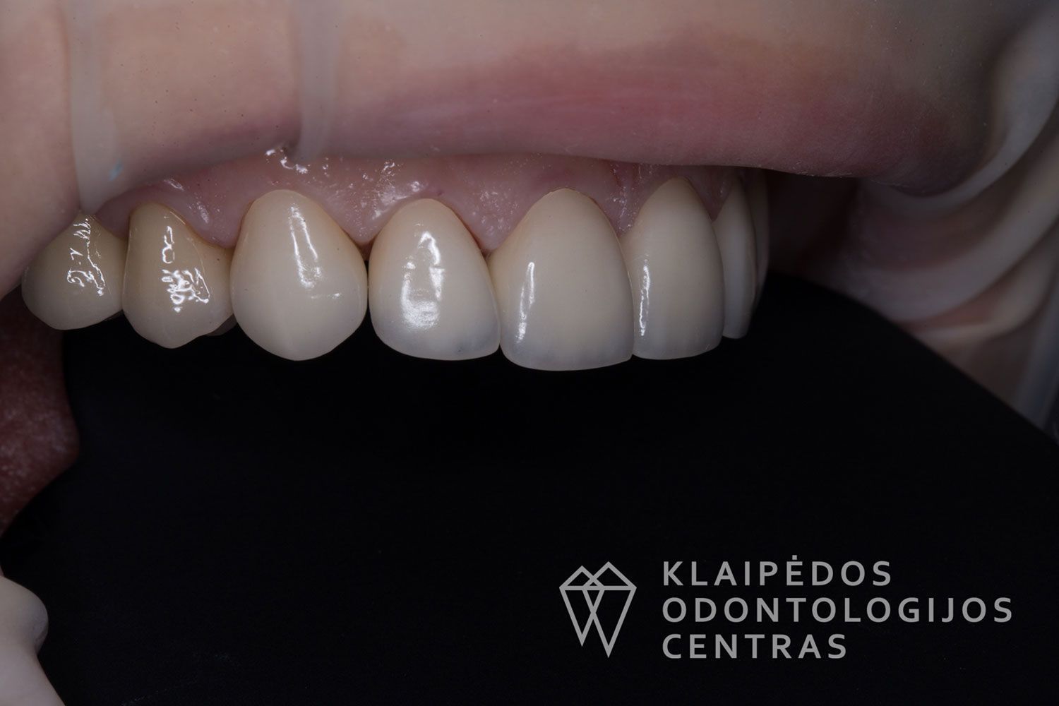 Priekinių dantų laminatės