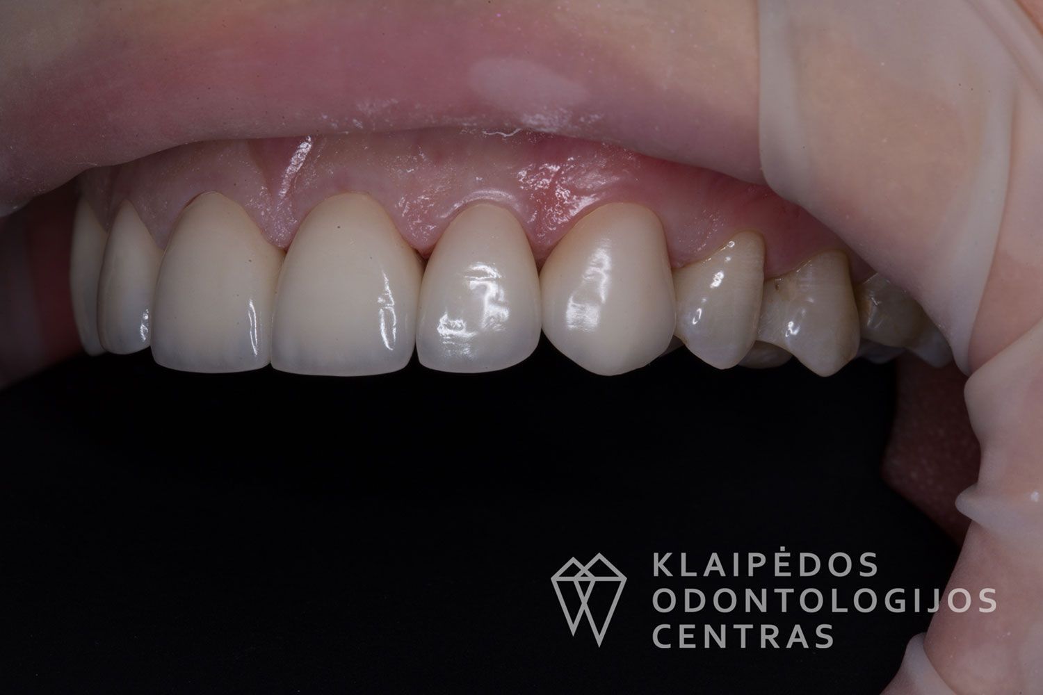 Priekinių dantų laminatės