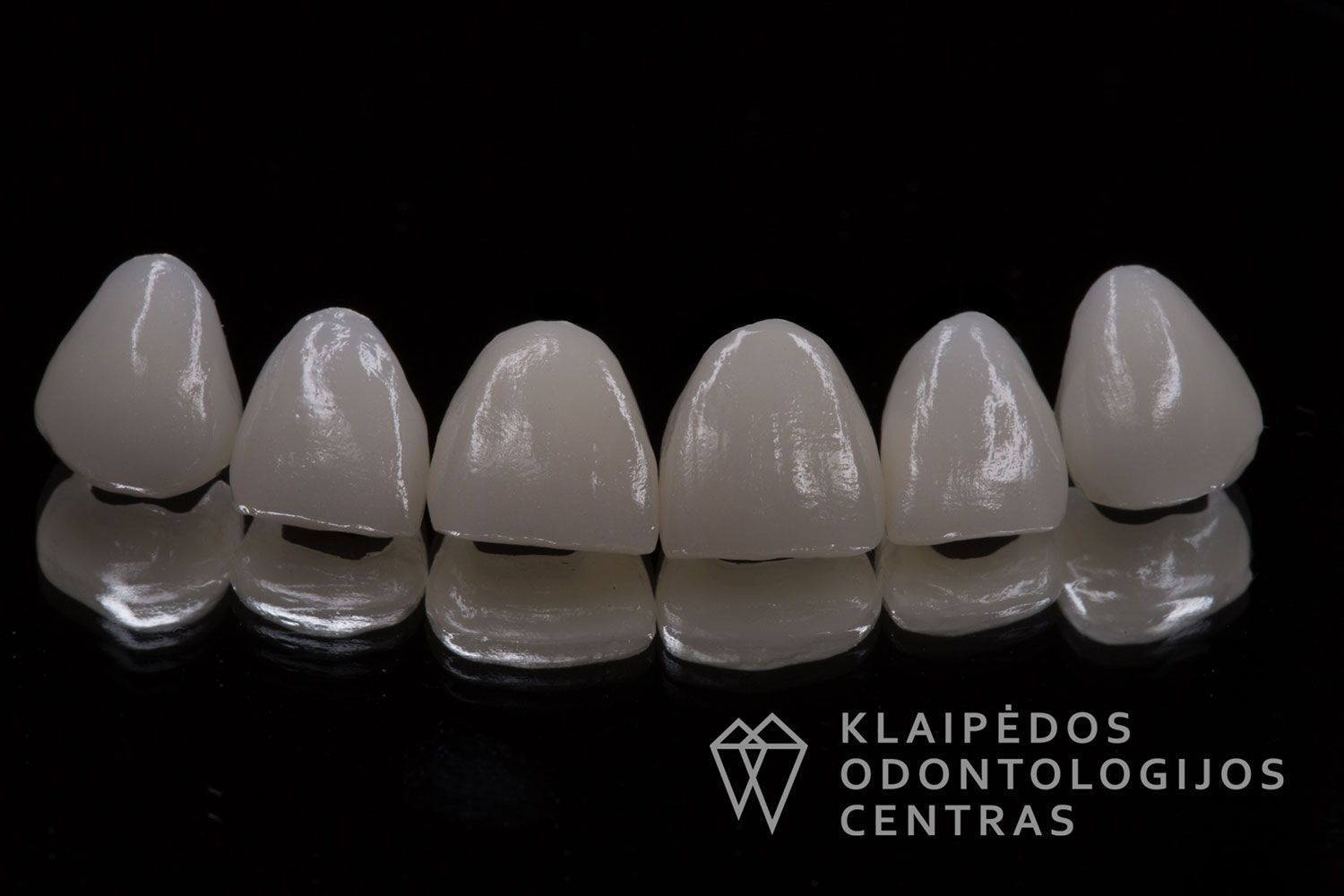 Priekinių dantų laminatės