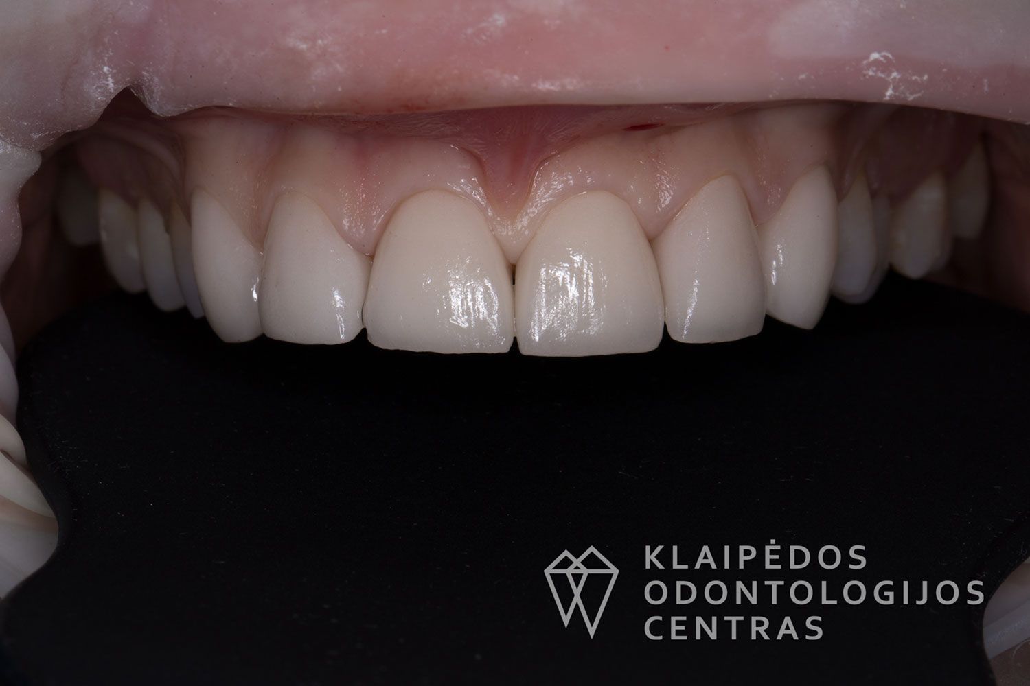 Priekinių dantų laminatės