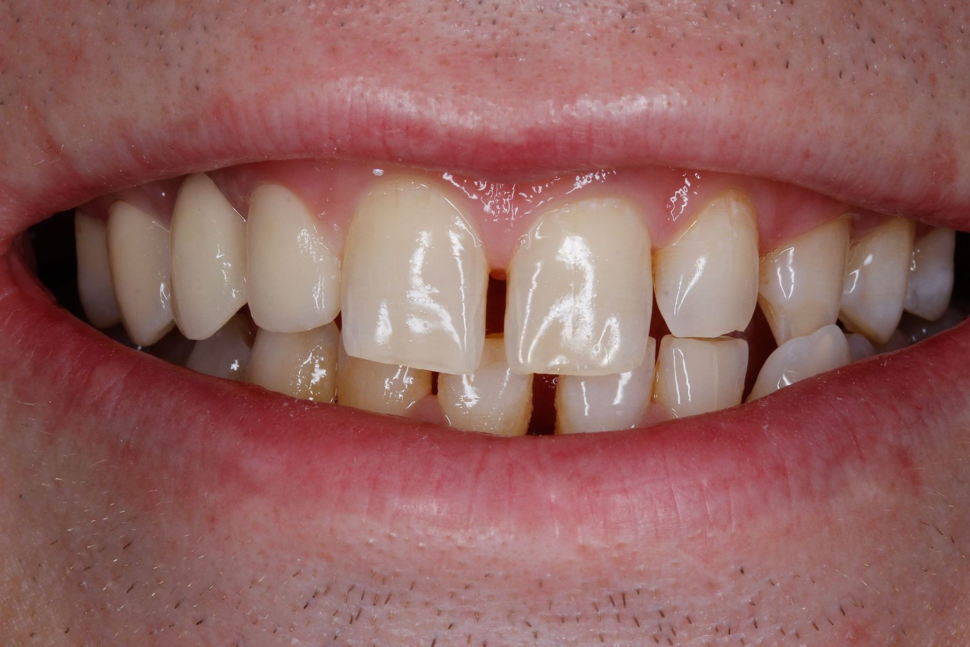 Priekinių dantų cirkonio keramikos vainikėliai