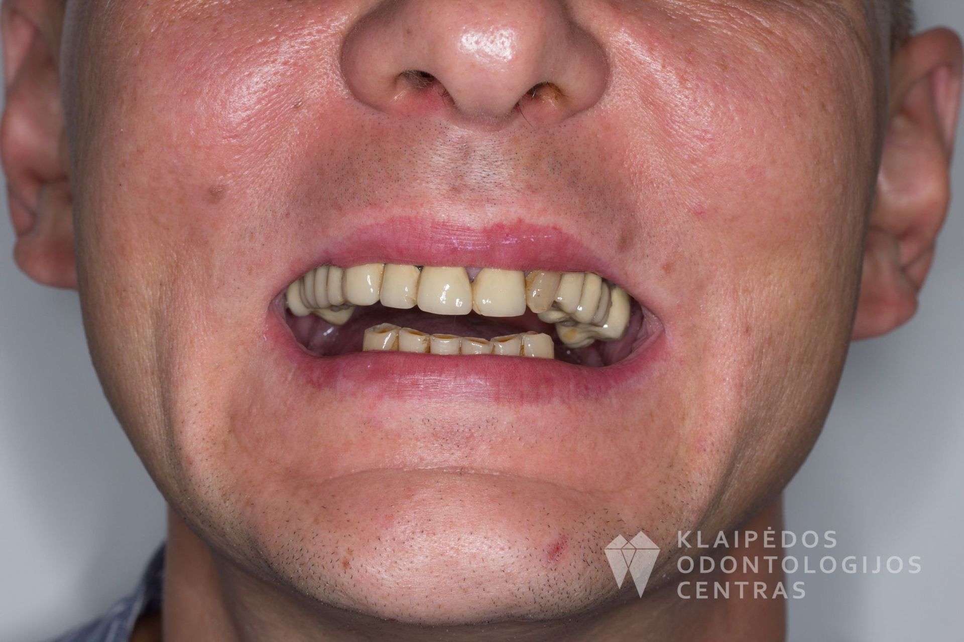 Visų dantų protezavimas cirkonio keramikos vainikėliais ant dantų ir implantų - prieš