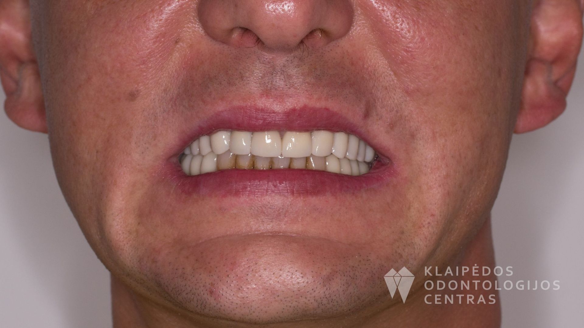 Visų dantų protezavimas cirkonio keramikos vainikėliais ant dantų ir implantų - po