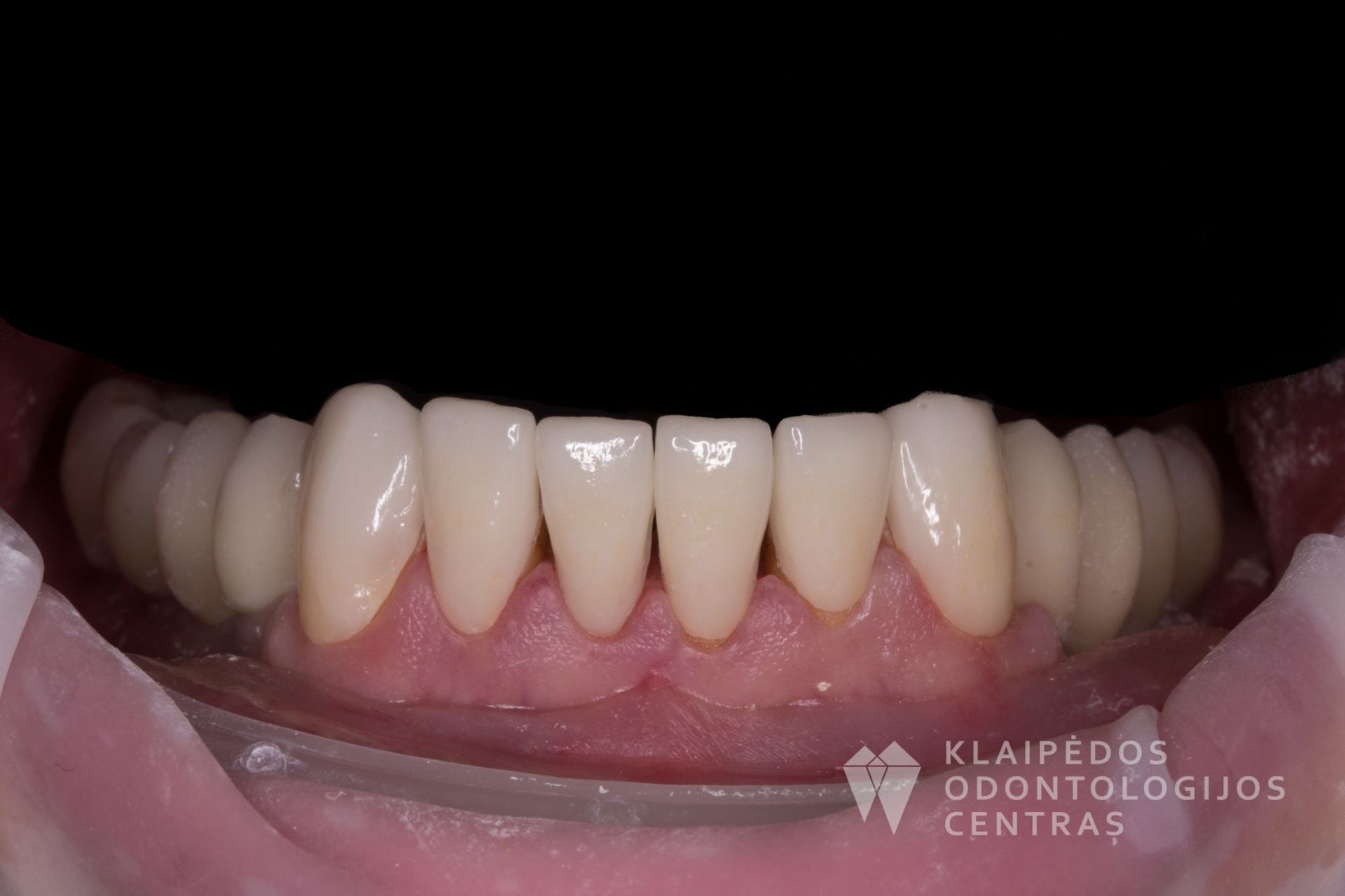 Visų dantų protezavimas cirkonio keramikos vainikėliais ant dantų ir implantų