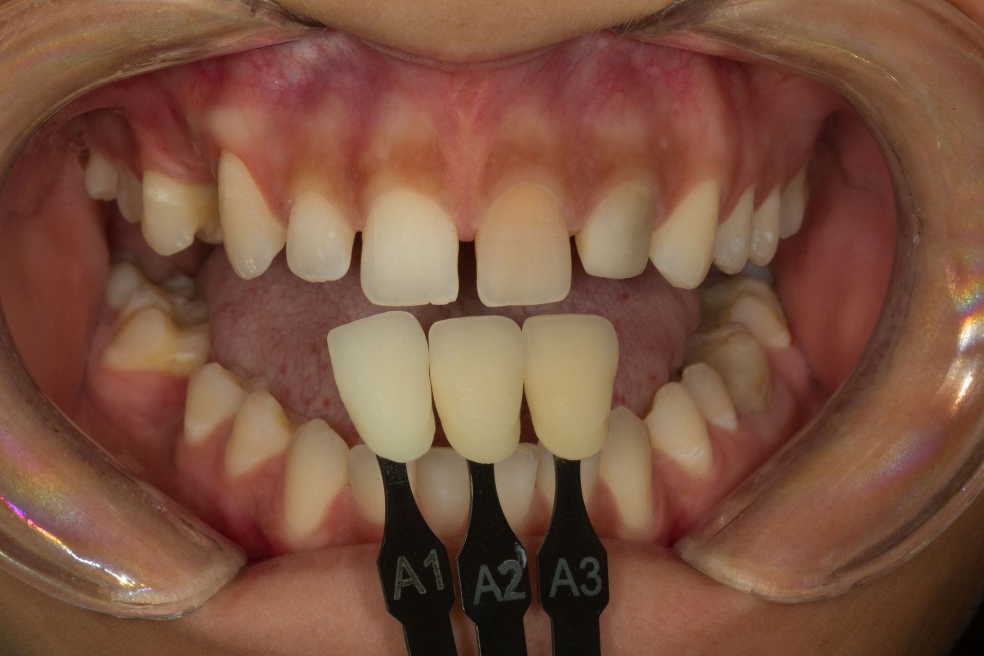 Šešių priekinių dantų laminatės - prieš