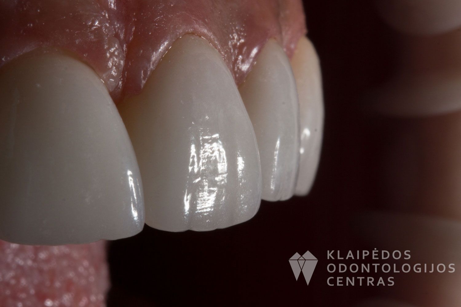 Šešių priekinių dantų laminatės