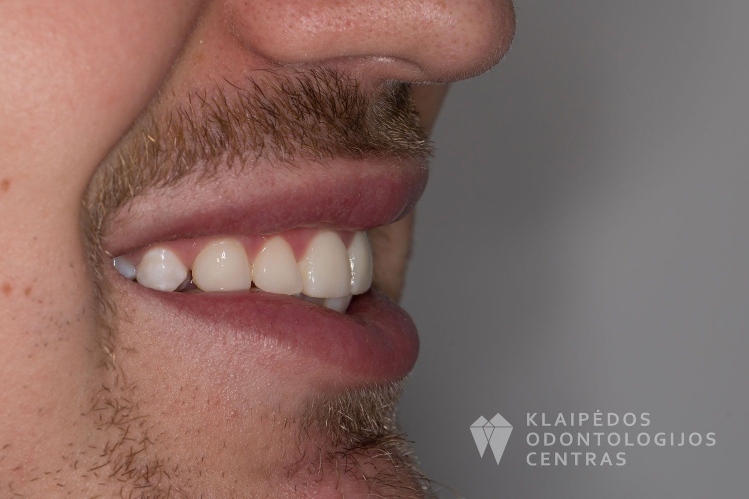 Šešių dantų estetinis plombavimas