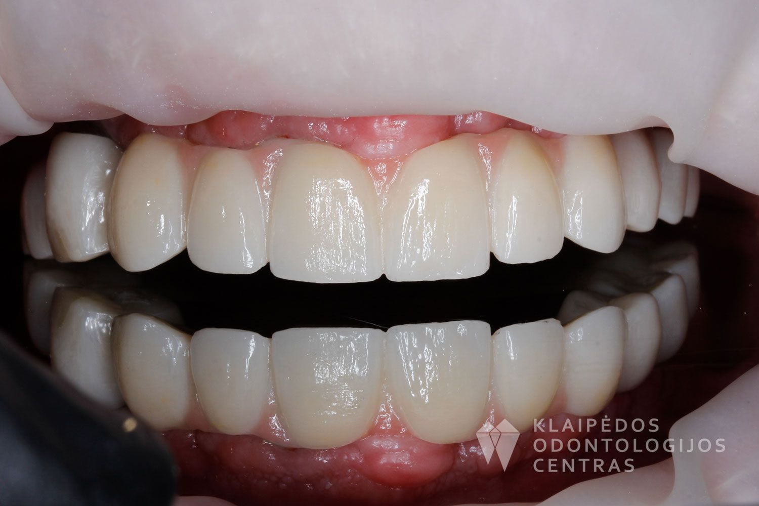 Cirkonio keramika ant 4 implantų