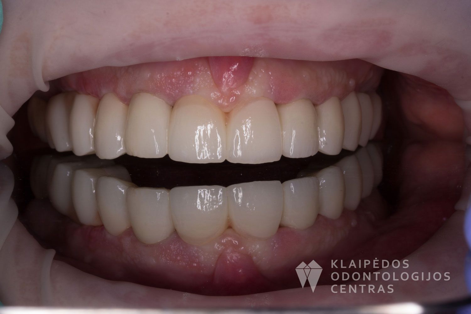 Cirkonio keramika ant 4 implantų