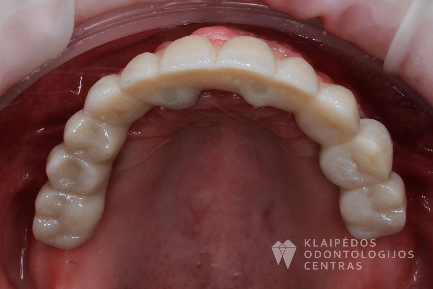 Cirkonio keramika ant 4 implantų