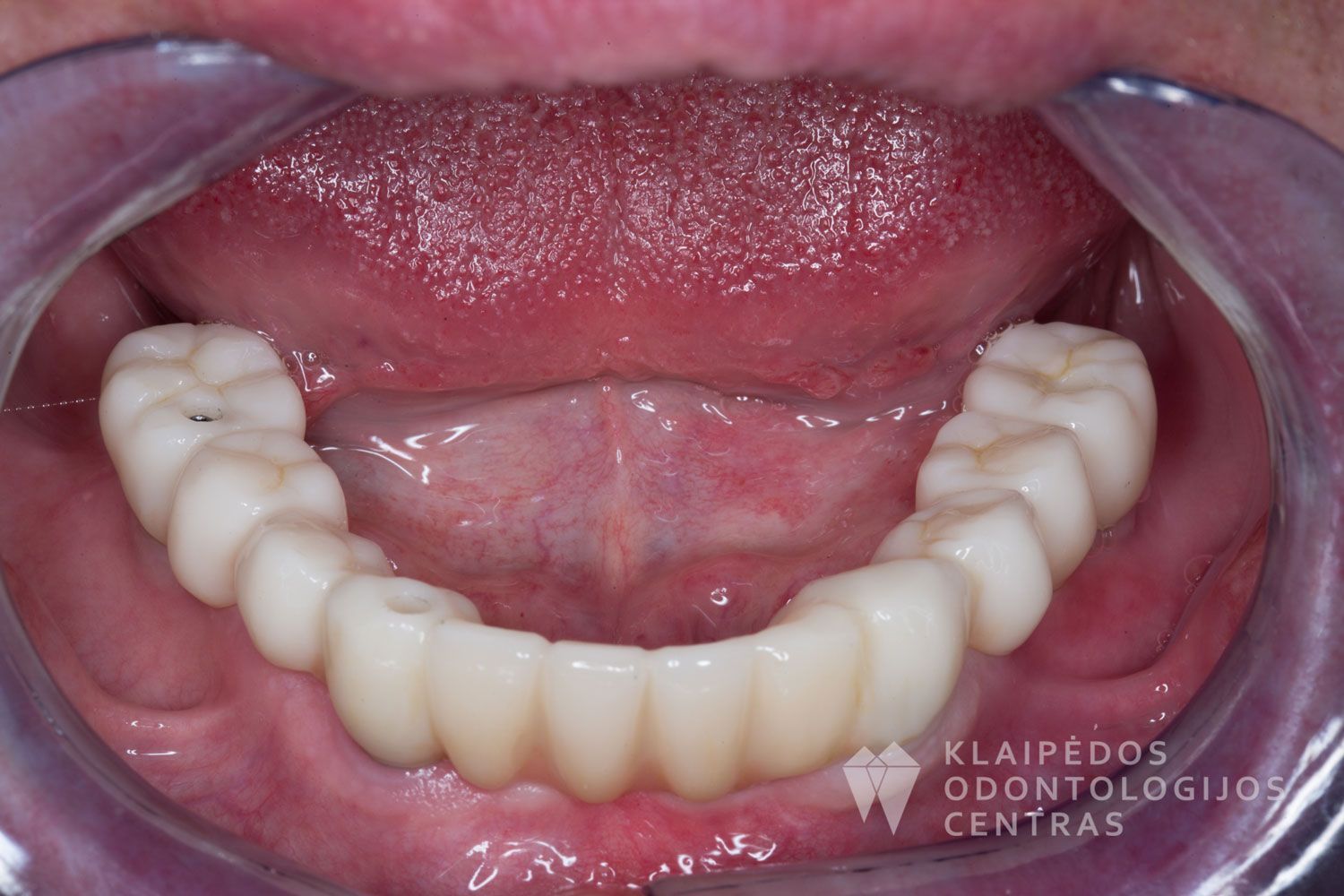 Cirkonio keramika ant 4 implantų