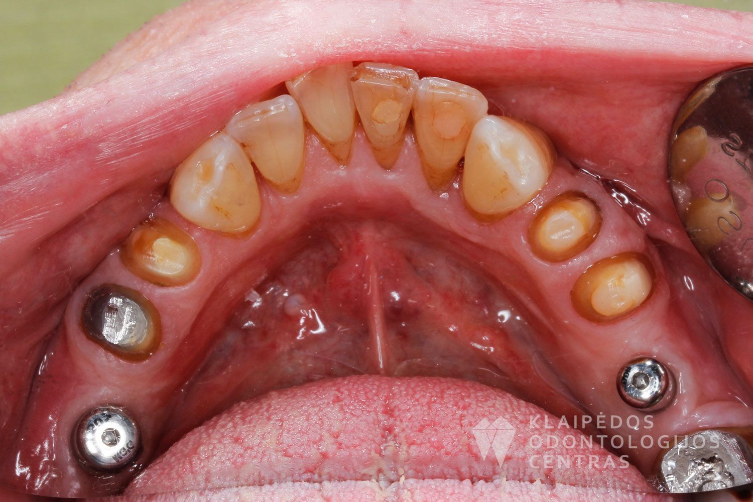 Dantų ir implantų protezavimas cirkonio keramika - prieš