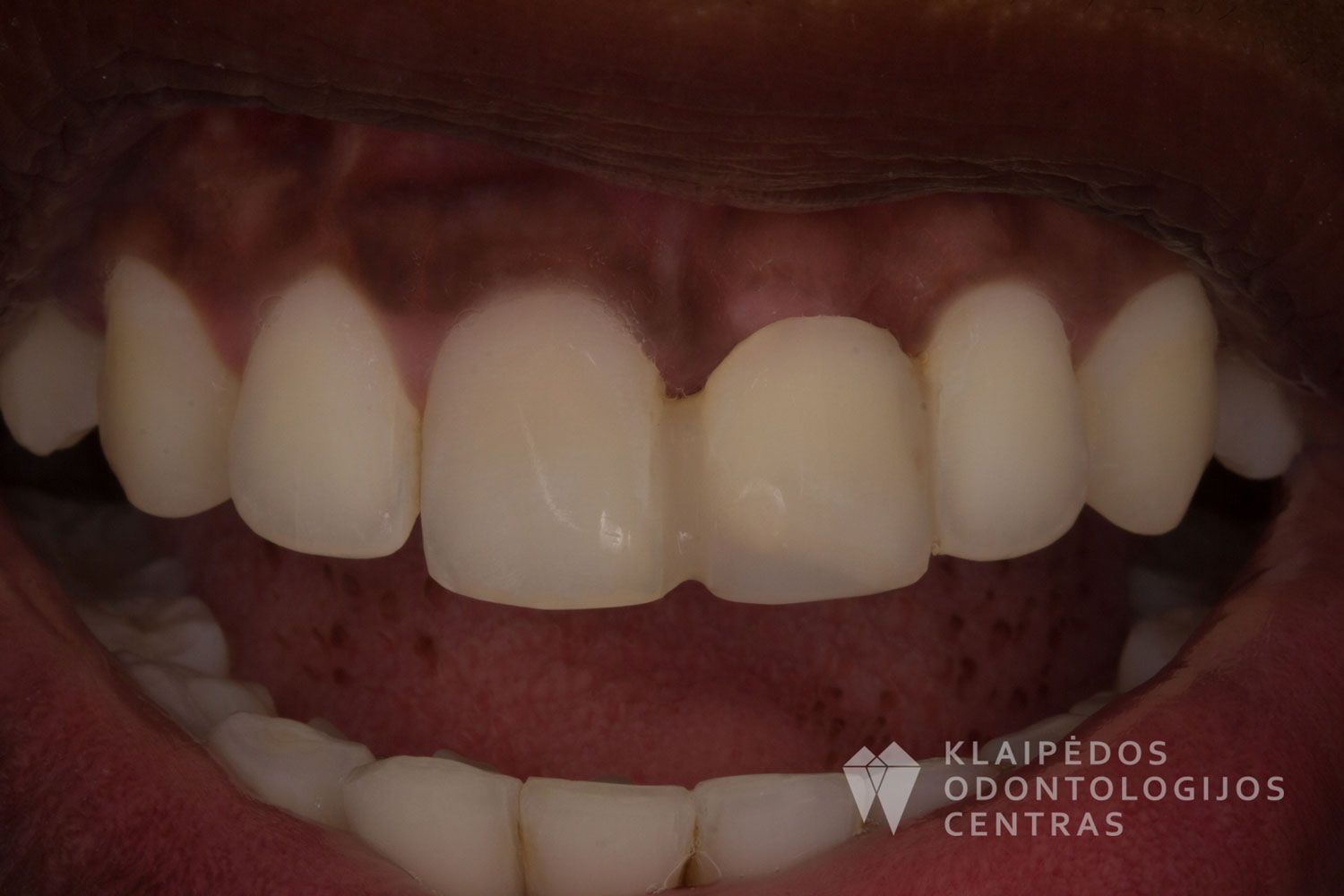 Priekinio danties cirkonio keramika