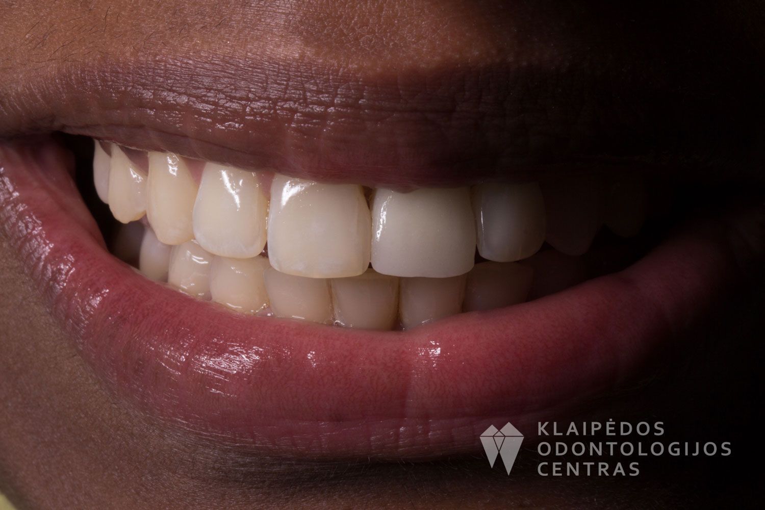 Priekinio danties cirkonio keramika