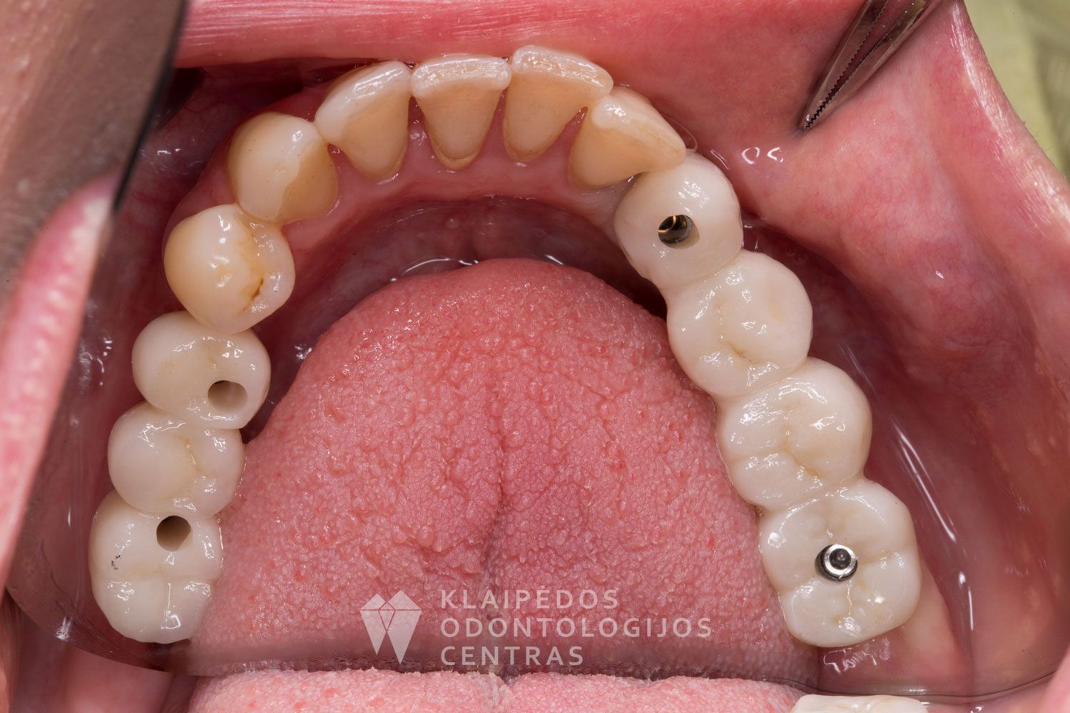 Cirkonio keramikos tiltas ant implantų