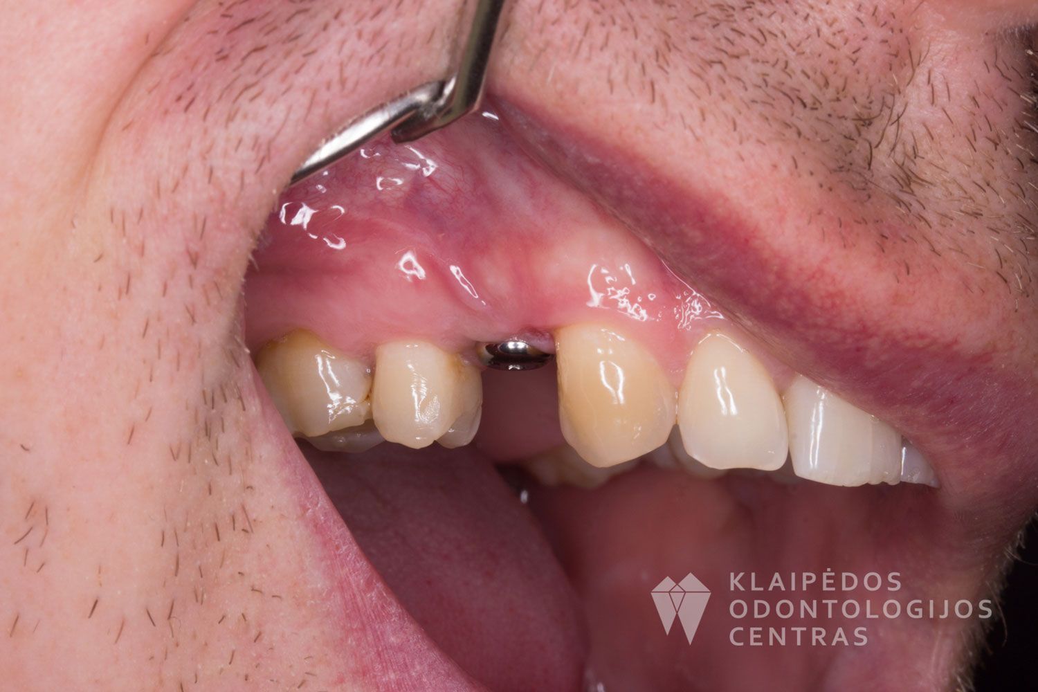 Cirkonio keramikos vainikėlis ant implanto