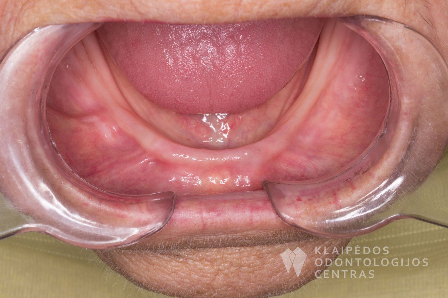 Lanko protezas ant 3 mini implantų