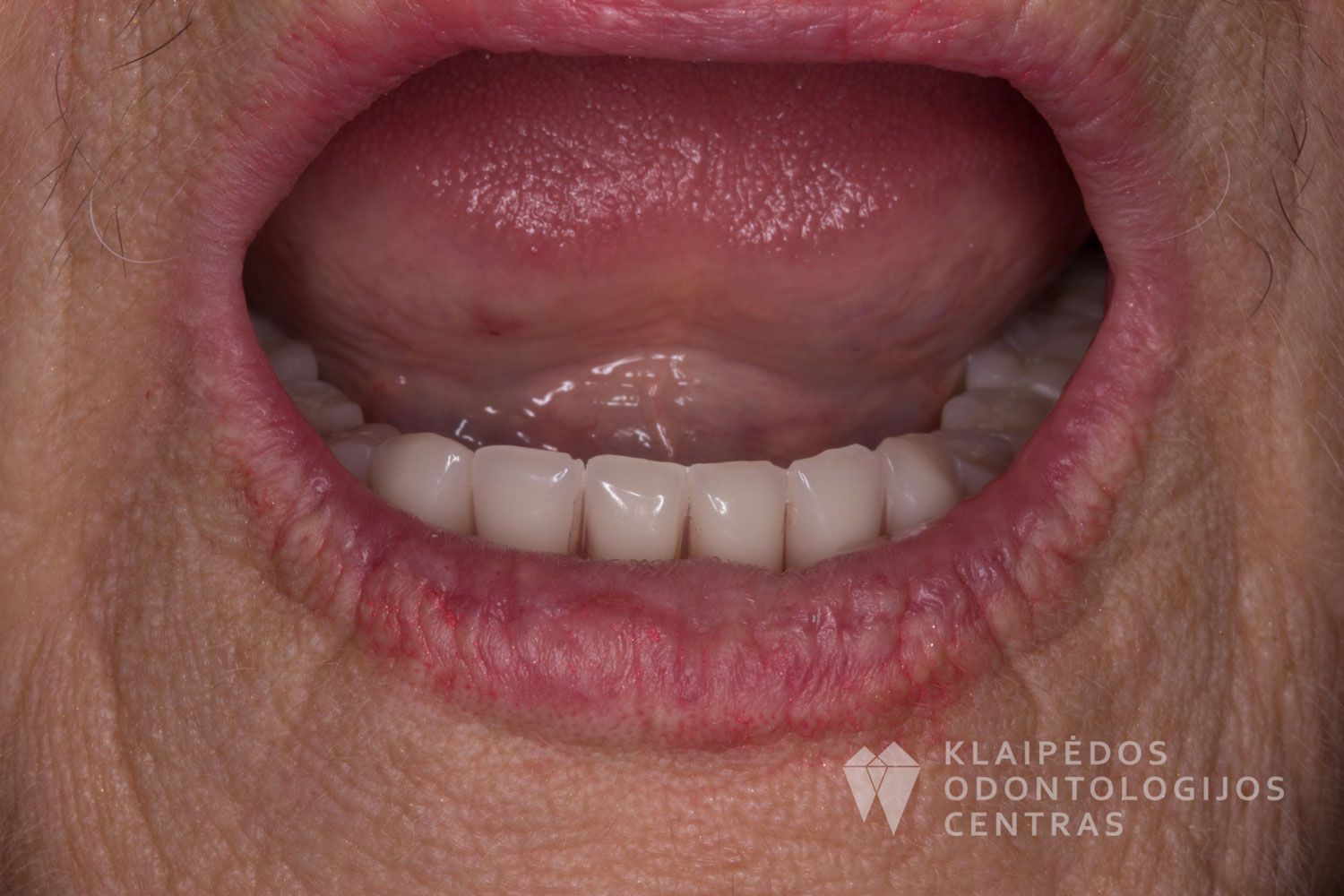 Lanko protezas ant 3 mini implantų