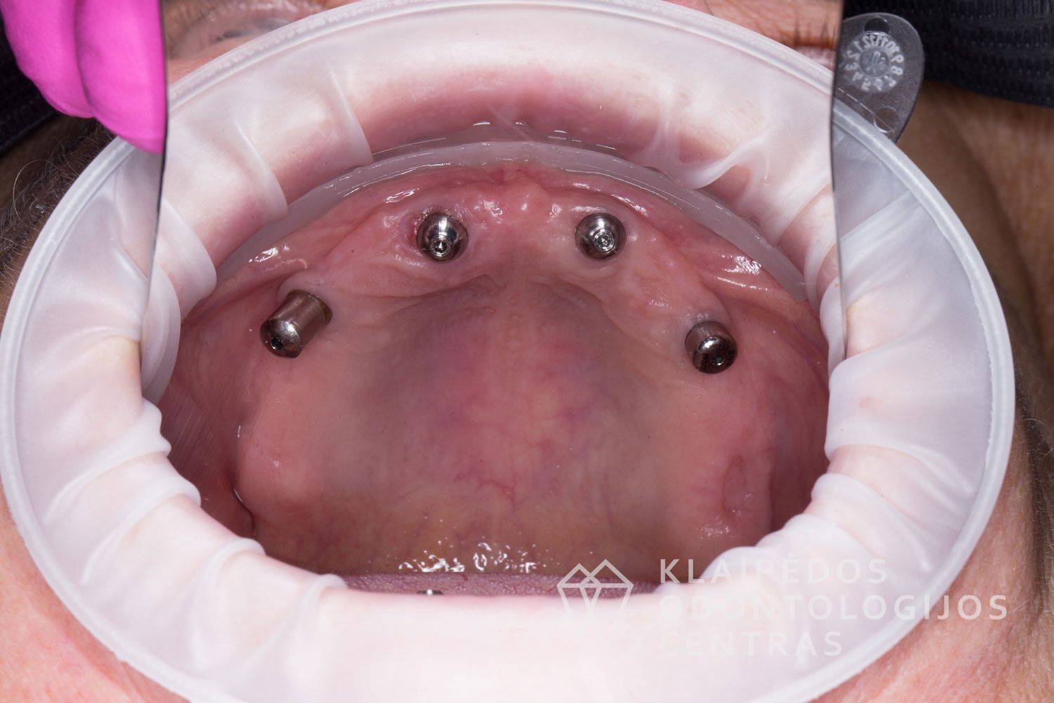 Cirkonio keramika ant 4 implantų